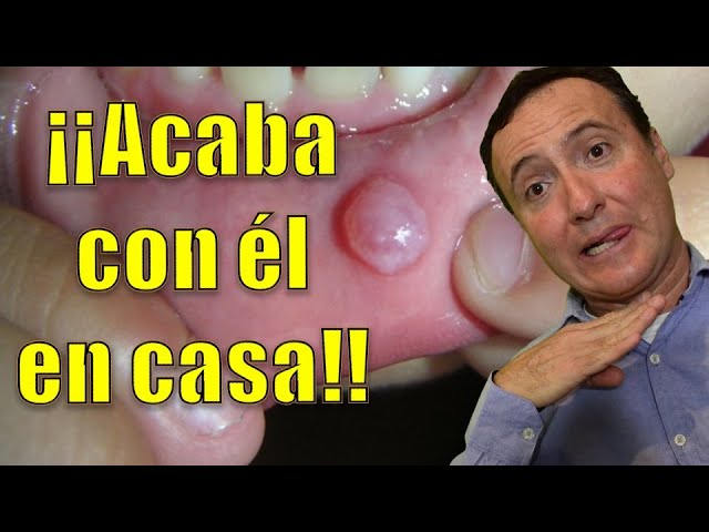 mucocele-remedios-caseros
