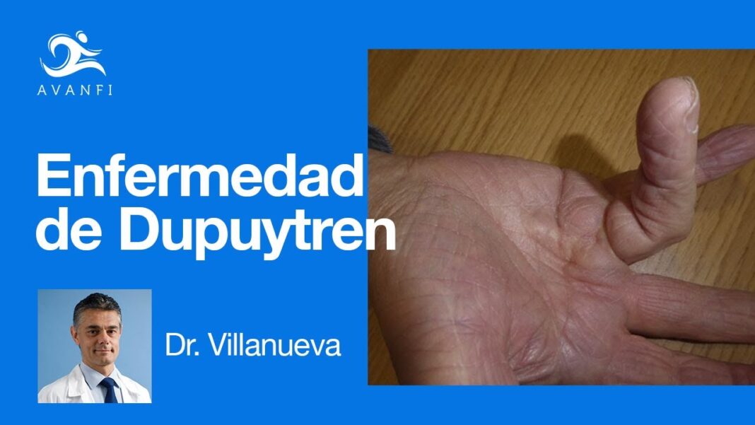 remedios-caseros-para-dupuytren