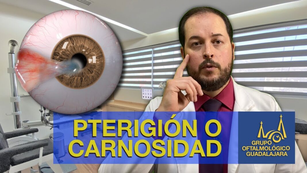 carnosidad-en-los-ojos-remedios-caseros