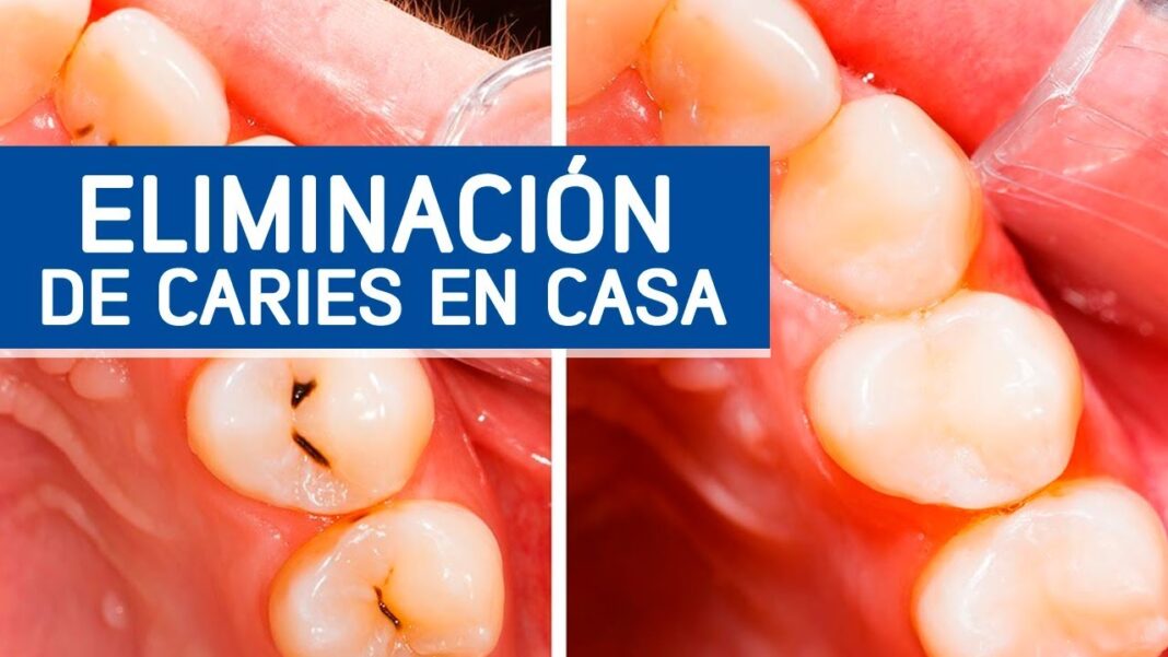 como-quitar-caries-con-remedios-caseros