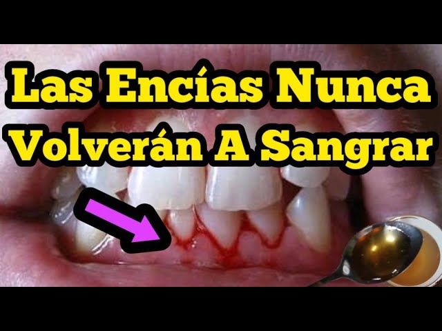 remedio-casero-para-el-sangrado-de-las-encias
