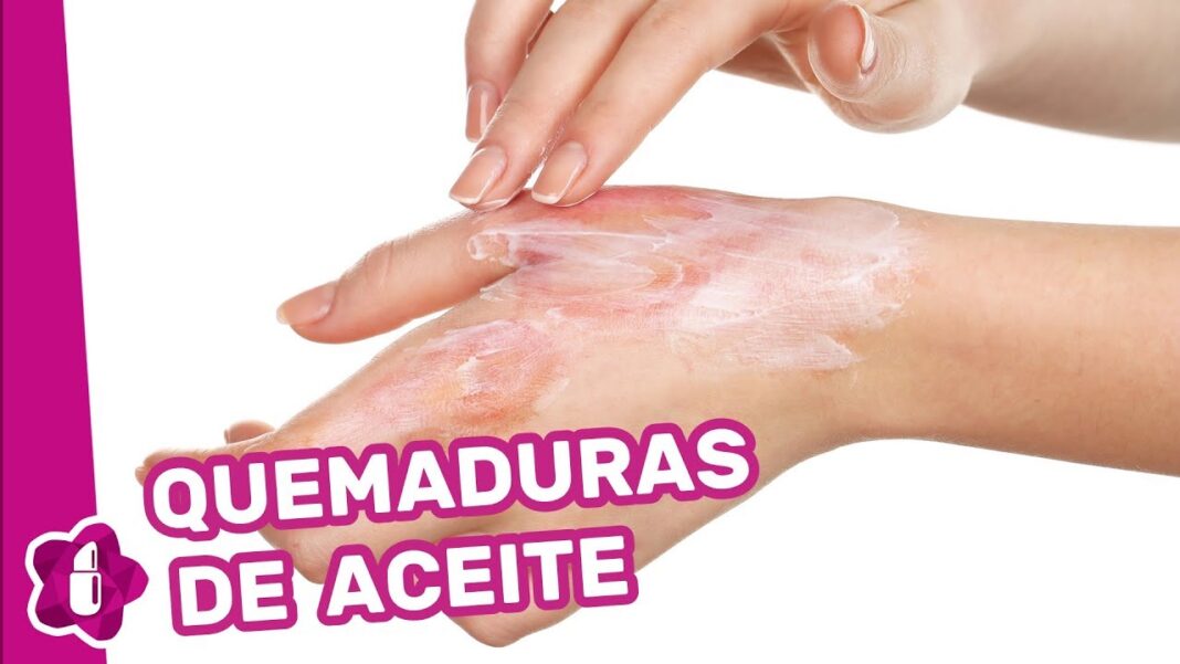 remedio-casero-para-quemaduras-con-aceite-de-cocina