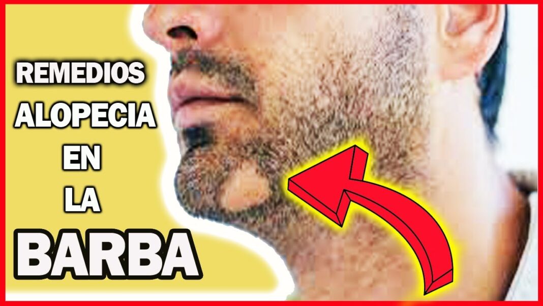 remedios-caseros-para-alopecia-areata-barba