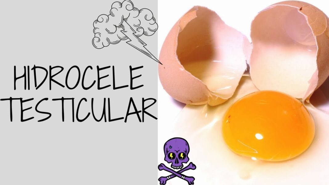remedios-caseros-para-hidrocele-testicular