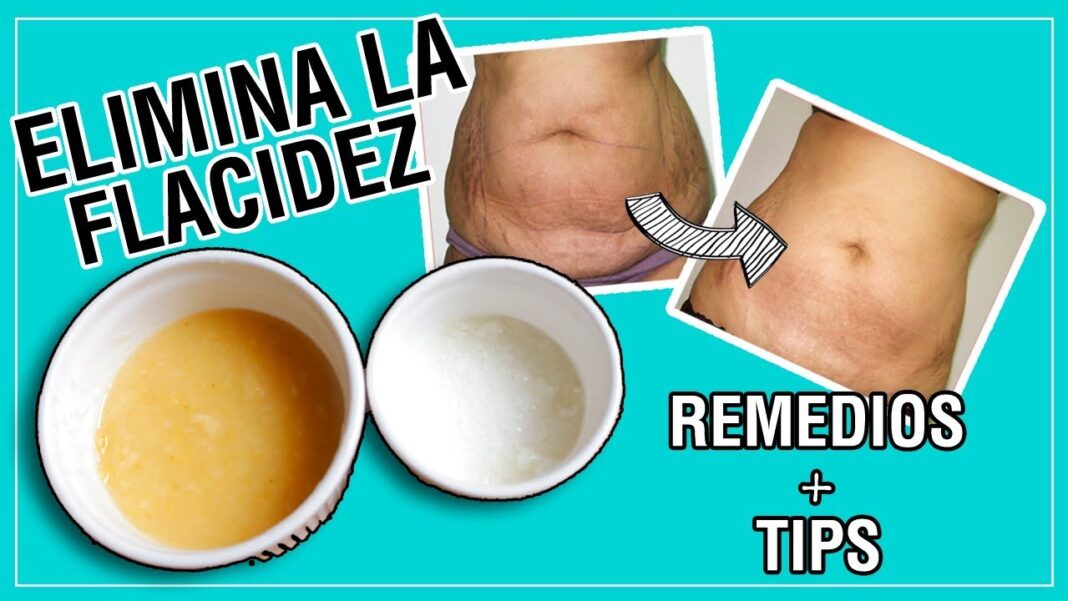remedios-caseros-para-la-flacidez-abdominal