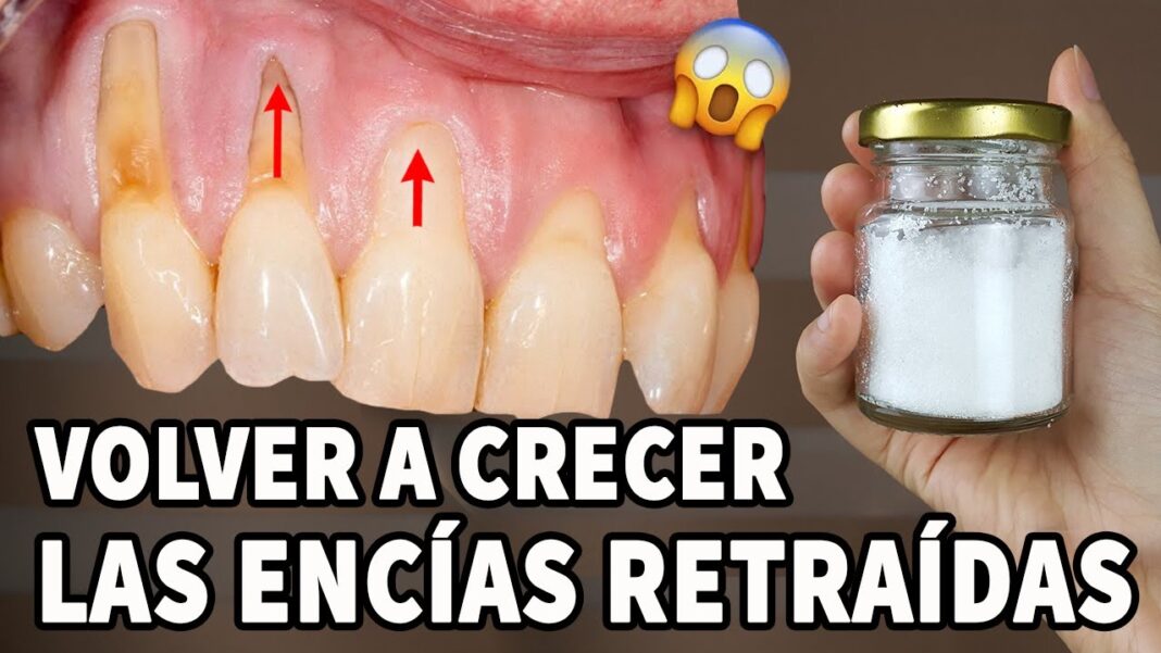 remedios-caseros-para-la-perdida-de-hueso-en-las-encias