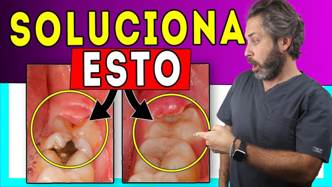remedios-caseros-para-la-pericoronitis
