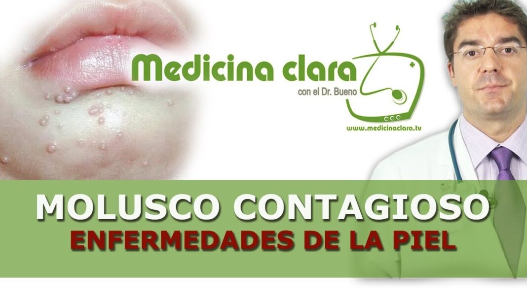 remedios-caseros-para-moluscos-en-ninos