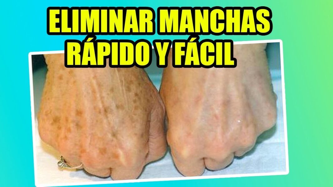 remedios-caseros-para-quitar-las-manchas-de-las-manos