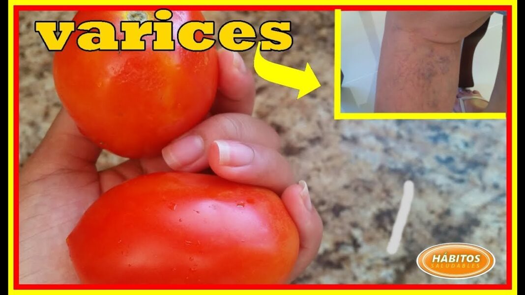 remedio-casero-para-las-varices-con-tomate