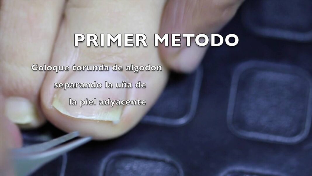 remedio-caseros-para-unas-encarnadas