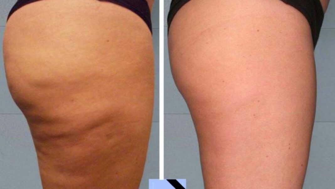 remedios-caseros-para-celulitis-en-las-piernas