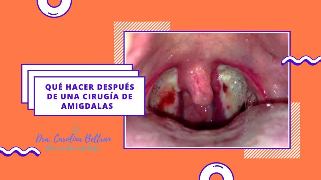 remedios-caseros-para-despues-de-operacion-de-amigdalas
