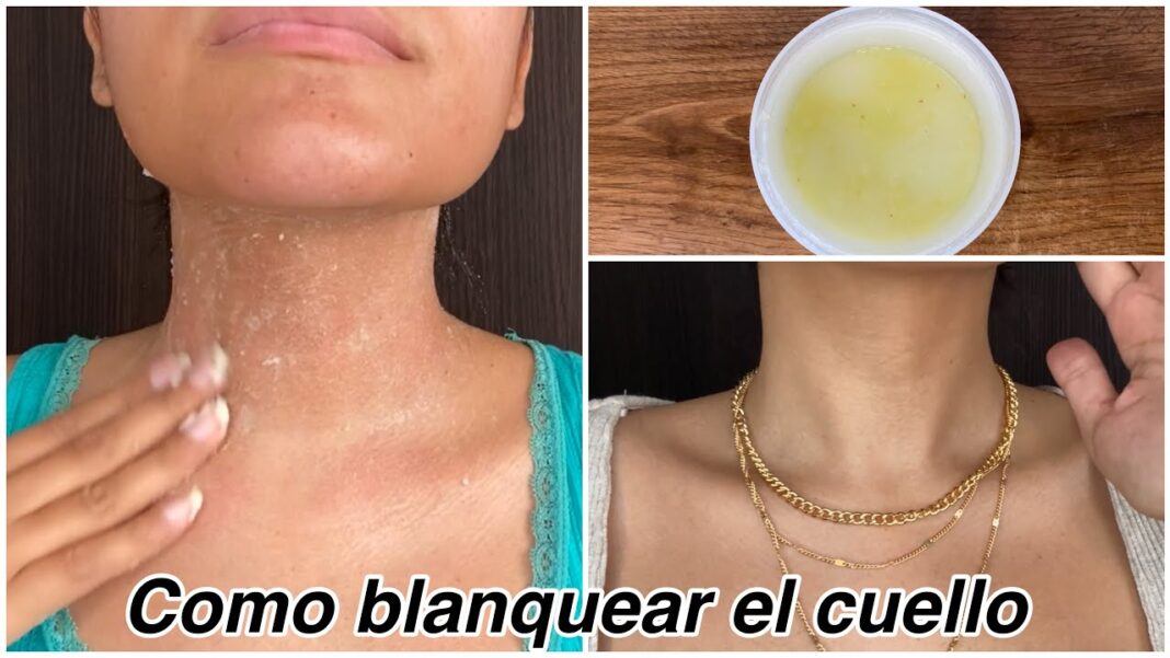 remedios-caseros-para-el-cuello-negro