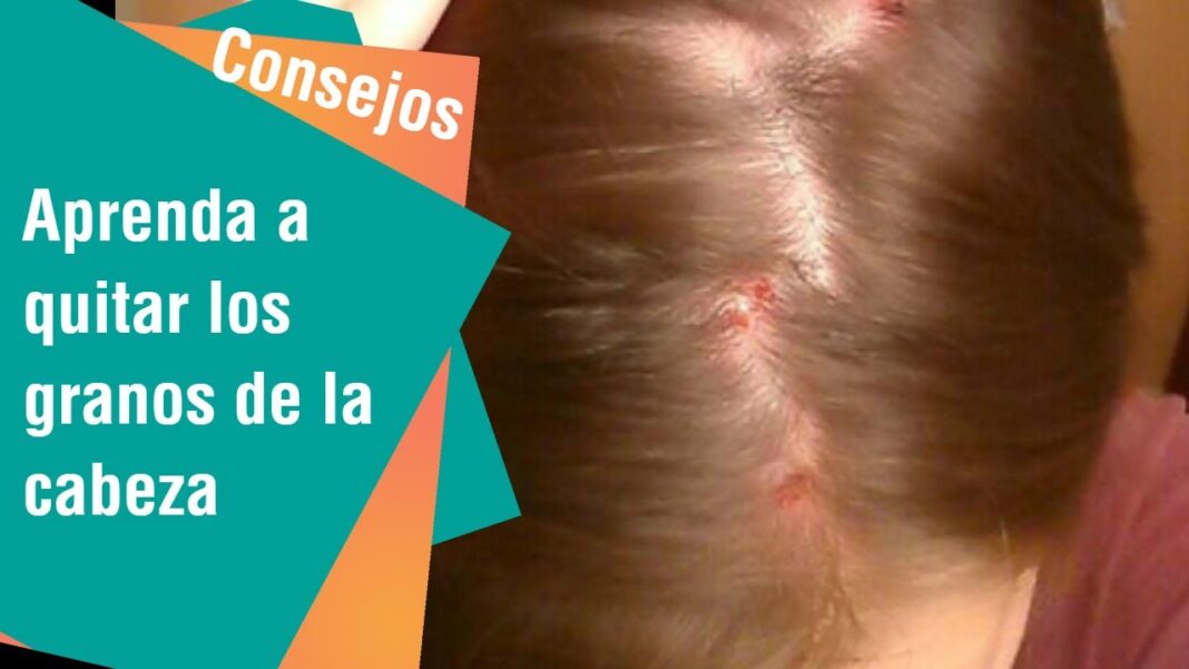 remedios-caseros-para-eliminar-granos-en-la-cabeza