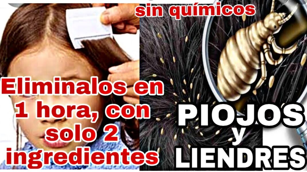 remedios-caseros-para-eliminar-liendres-muertas