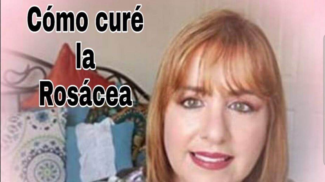 remedios-caseros-para-la-cuperosis-rosacea