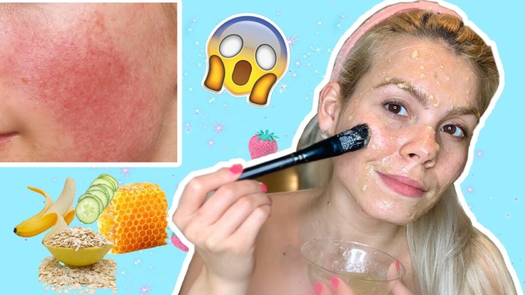 remedios-caseros-para-la-rosacea-en-la-cara