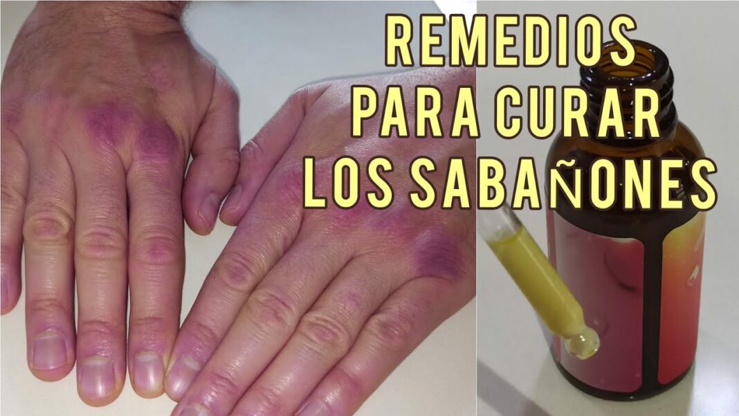 remedios-caseros-para-los-sabanones-en-las-manos