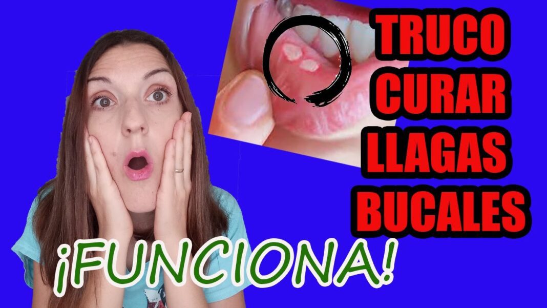 Aftas-en-los-labios-remedios-caseros