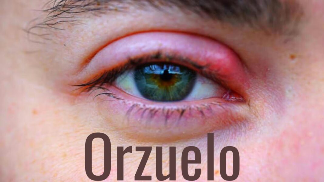 Como-curar-un-orzuelo-remedios-caseros