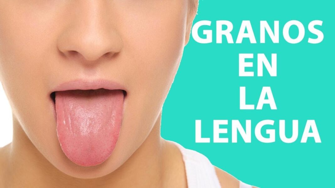 Granitos-en-la-lengua-remedio-casero