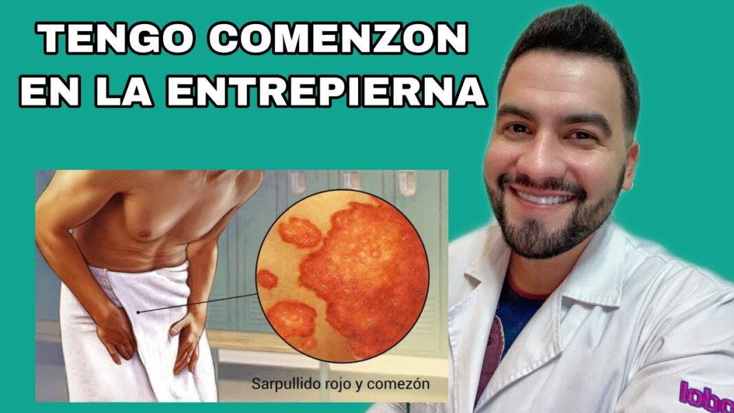 Picazon-entrepiernas-remedio-casero