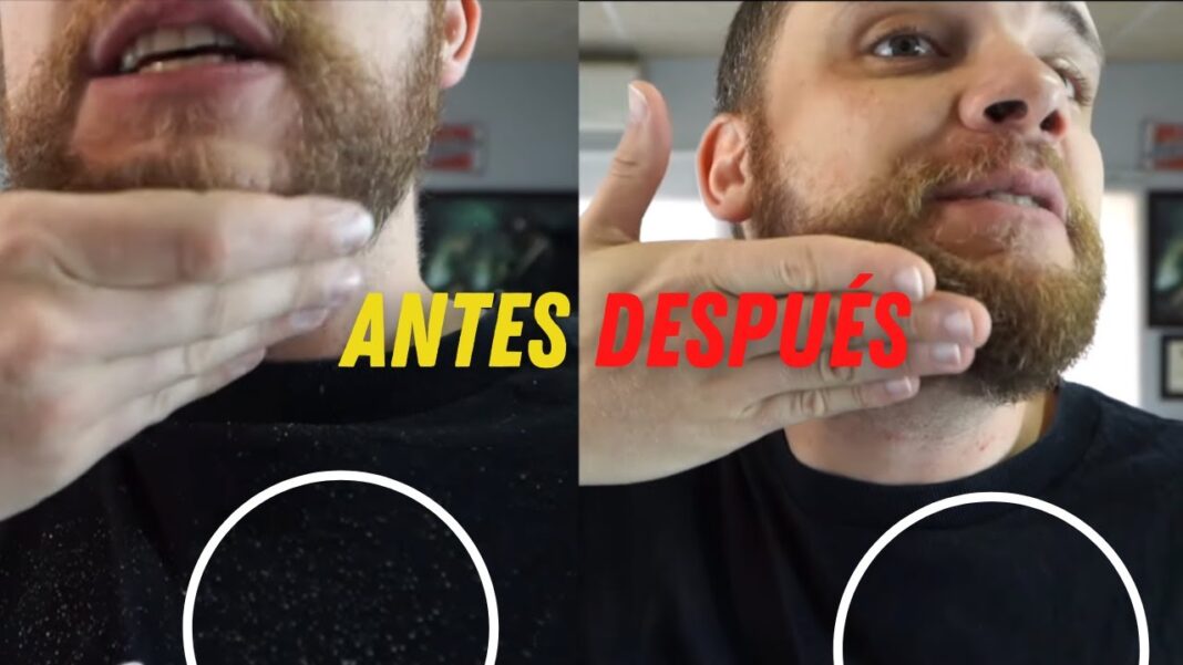 Remedio-casero-para-caspa-en-la-barba