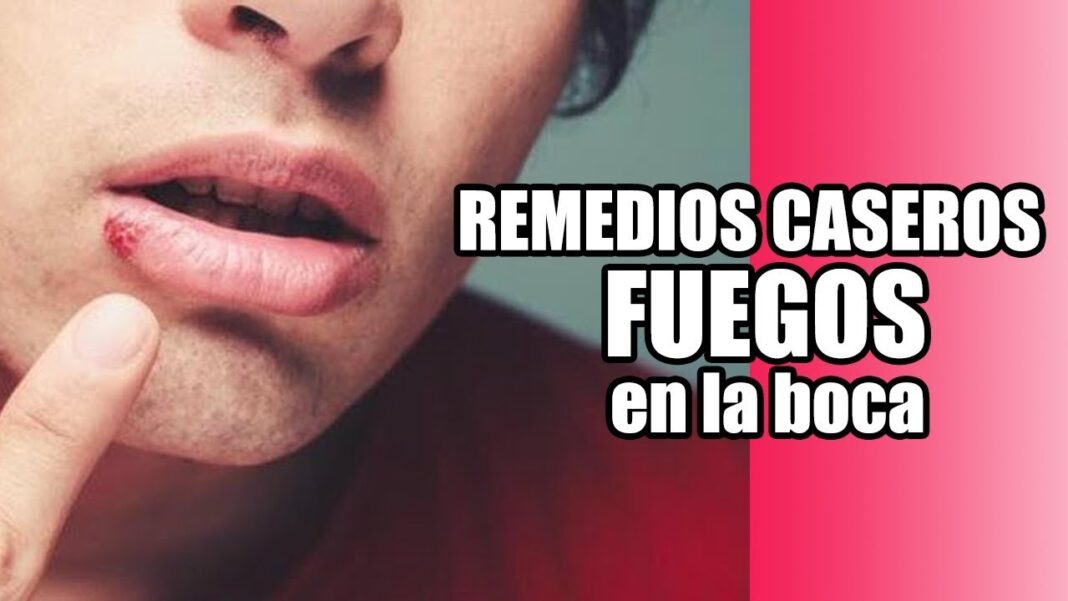 Remedio-casero-para-fogasos-en-la-boca
