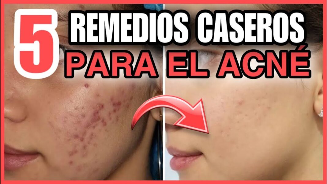 Remedio-casero-para-los-barros-en-la-cara