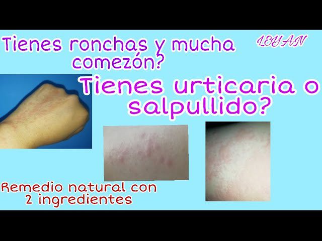 Remedio-casero-para-tratar-ronchas-en-la-piel