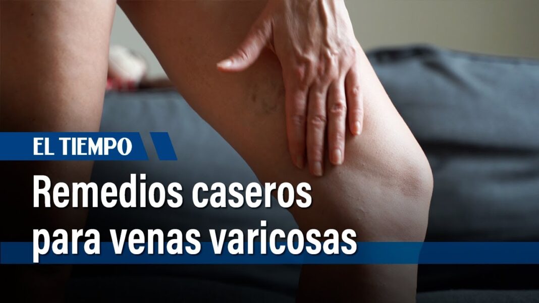 Remedio-casero-para-tratar-varices-gruesas