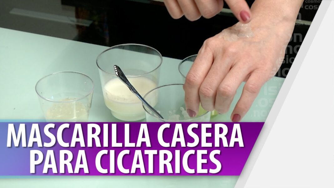 Remedios-caseros-para-cicatrices-quirurgicas