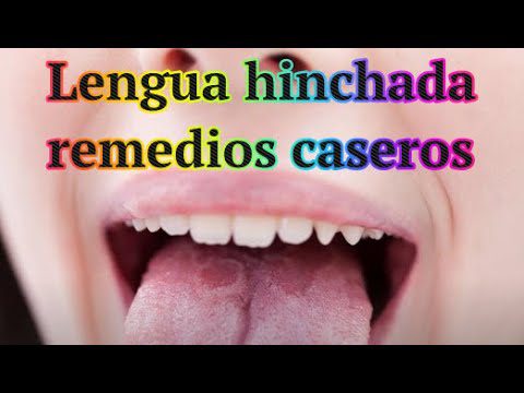 Remedios-caseros-para-desinflamar-la-lengua