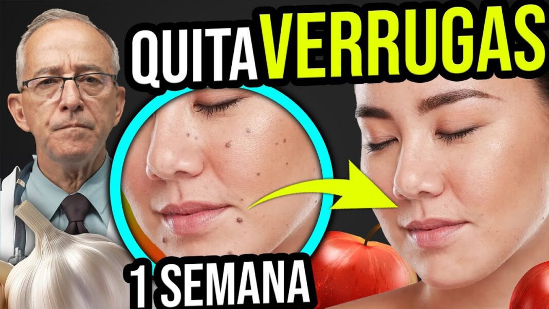 Remedios-caseros-para-eliminar-verrugas