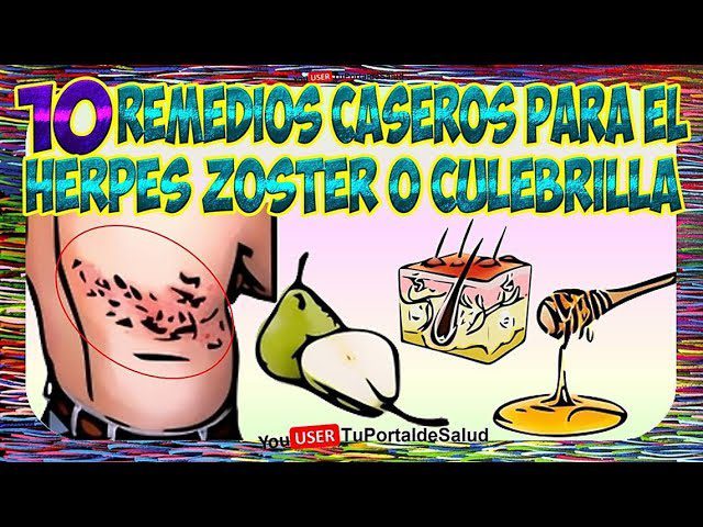 Remedios-caseros-para-herpes-zoster