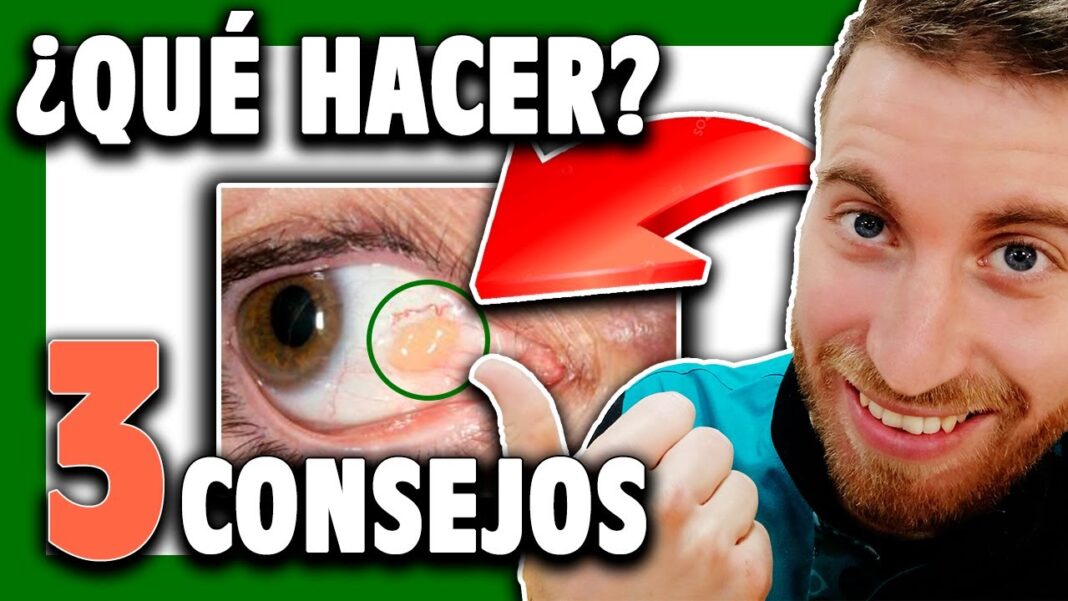 Remedios-caseros-para-la-carnosidad