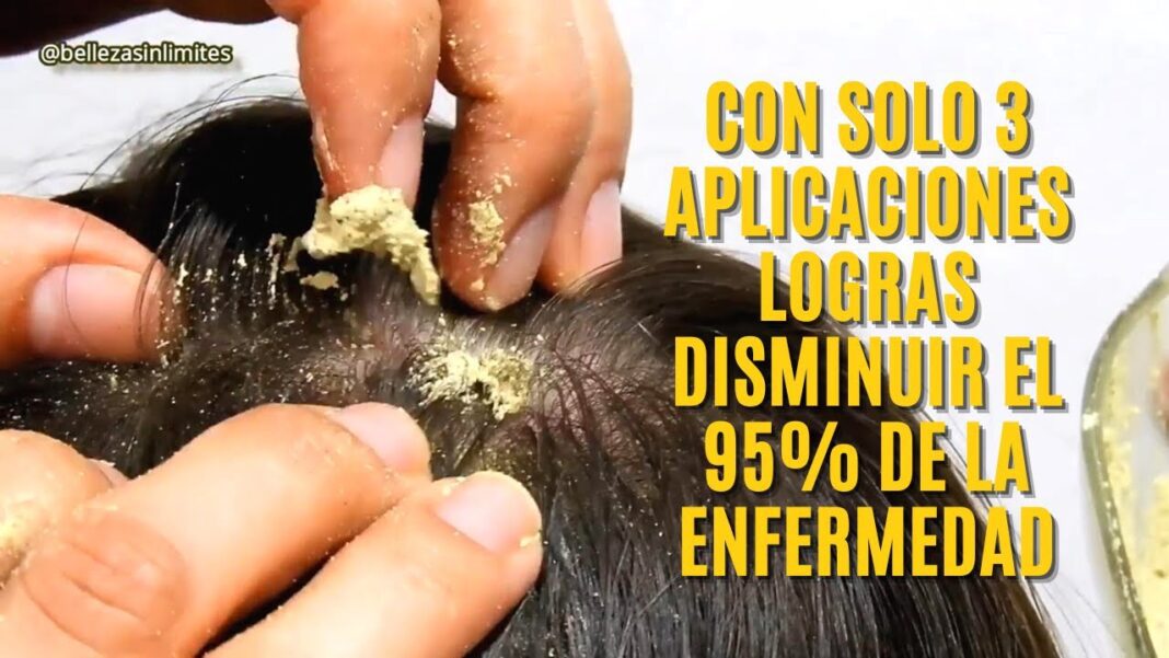 Remedios-caseros-para-la-dermatitis-seborreica