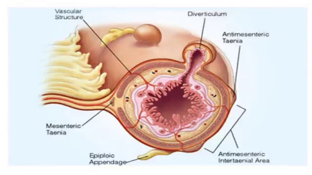Remedios-caseros-para-la-diverticulitis