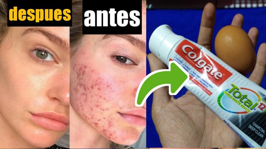 Remedios-caseros-para-los-puntos-negros-y-espinillas-1