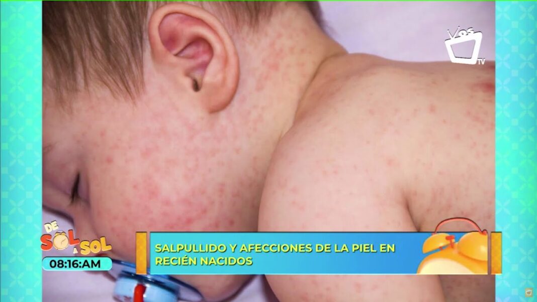 Sarpullido-remedio-casero