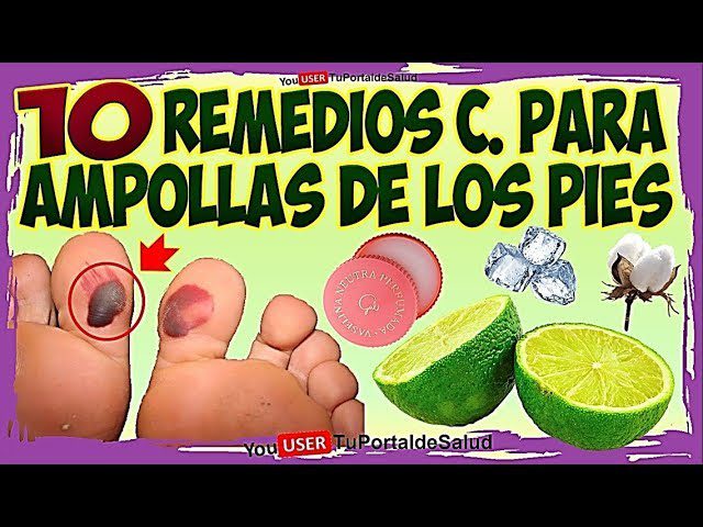 ampollas-en-los-pies-remedios-caseros