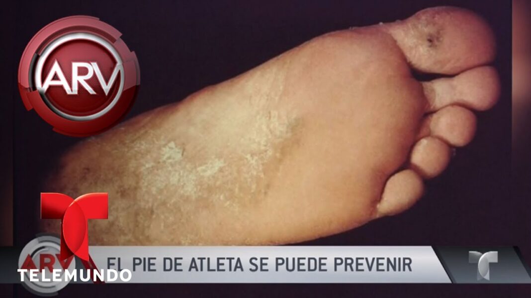 como-curar-el-pie-de-atleta-con-remedios-caseros