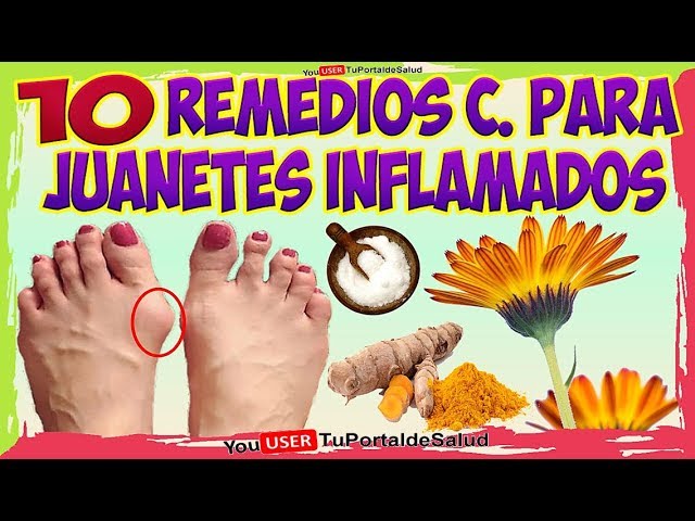 como-eliminar-juanetes-con-remedios-caseros