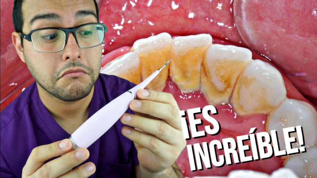 como-quitar-el-sarro-de-los-dientes