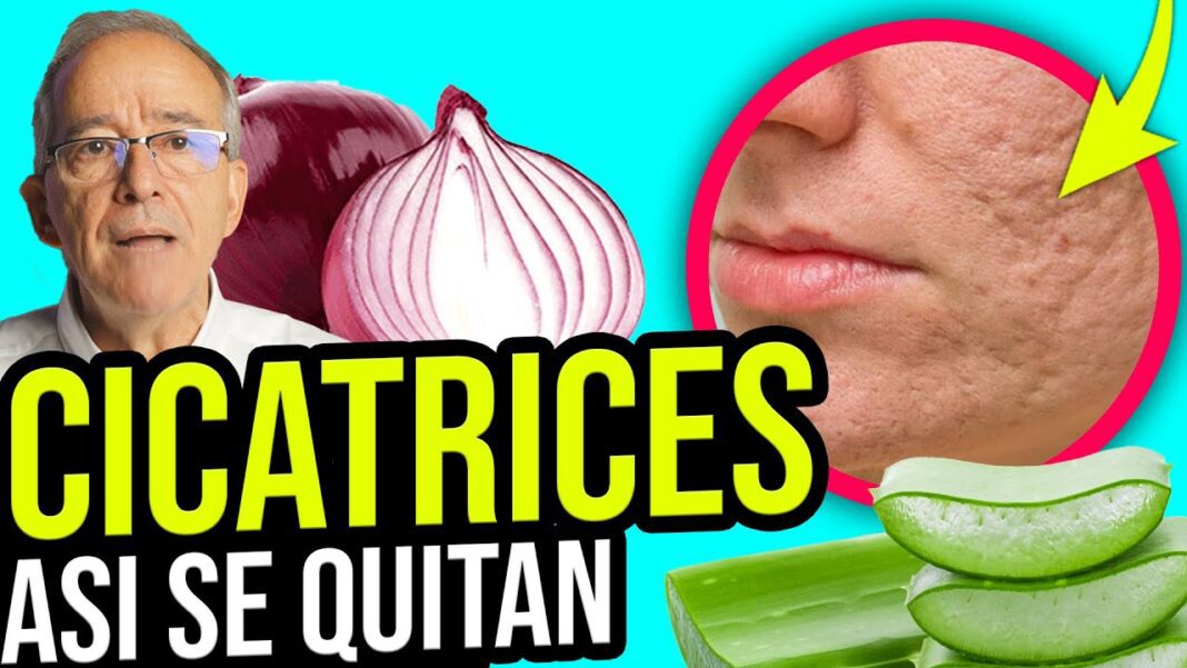 como-quitar-las-cicatrices-dela-cara-remedios-caseros
