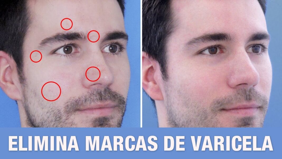 como-quitar-las-marcas-de-la-varicela-con-remedios-caseros-1