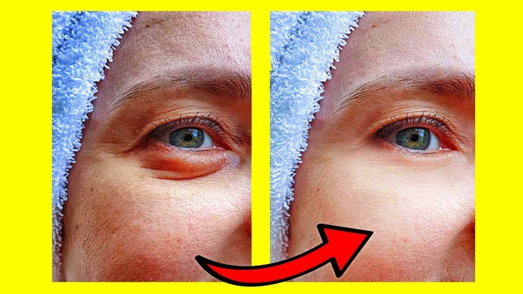 como-quitar-las-ojeras-y-bolsas-delos-ojos-remedios-caseros