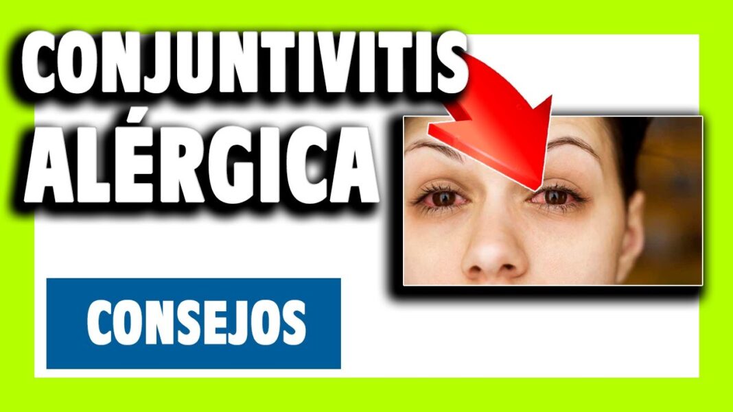 conjuntivitis-remedios-caseros