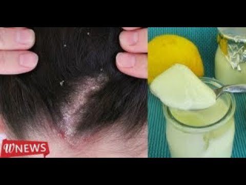 costras-en-la-cabeza-en-ninos-remedios-caseros